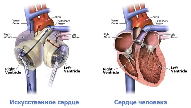 Искусственное сердце