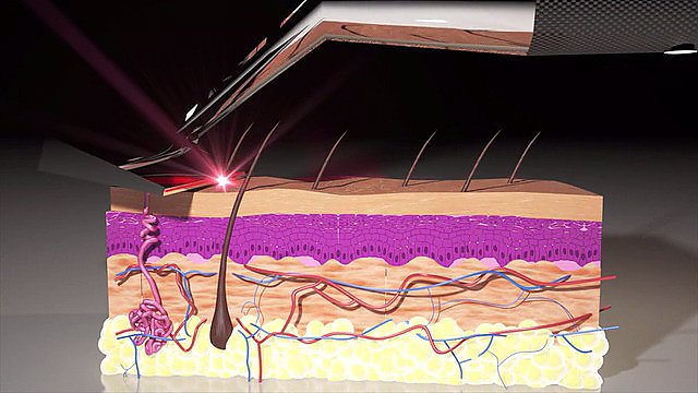 Skarp Laser Razor в действии