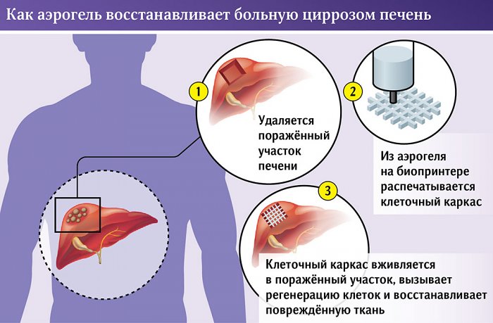 В России создан новый метод лечения цирроза печени